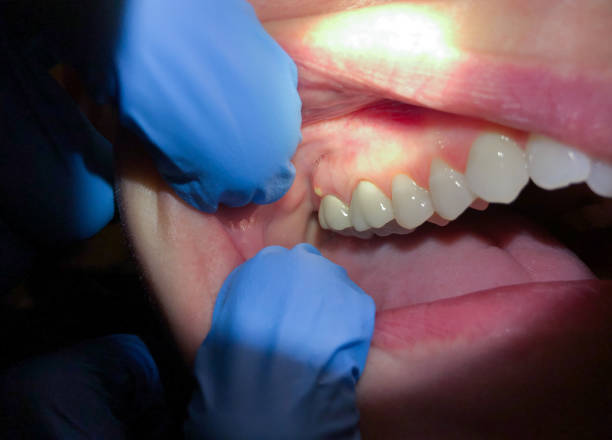 Best Emergency Dental Extractions in Holts Summit, MO